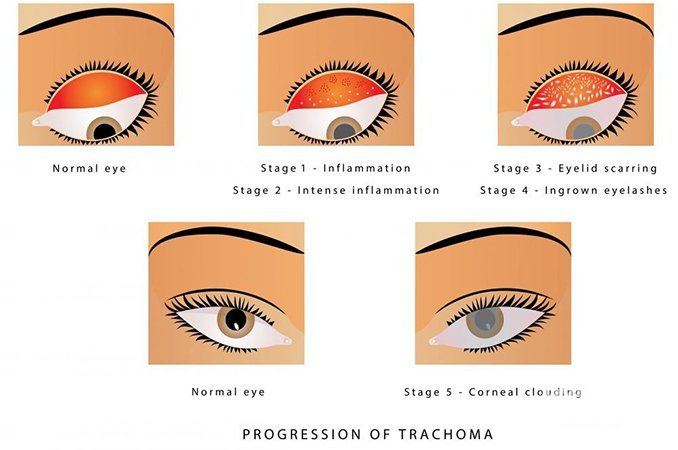Трахома – это инфекционное заболевание глаз