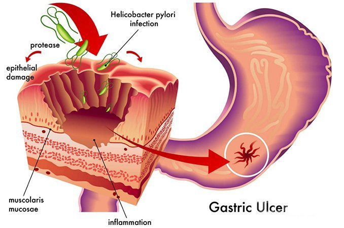 Эрозия желудка - эрозивное поражение слизистой оболочки органа