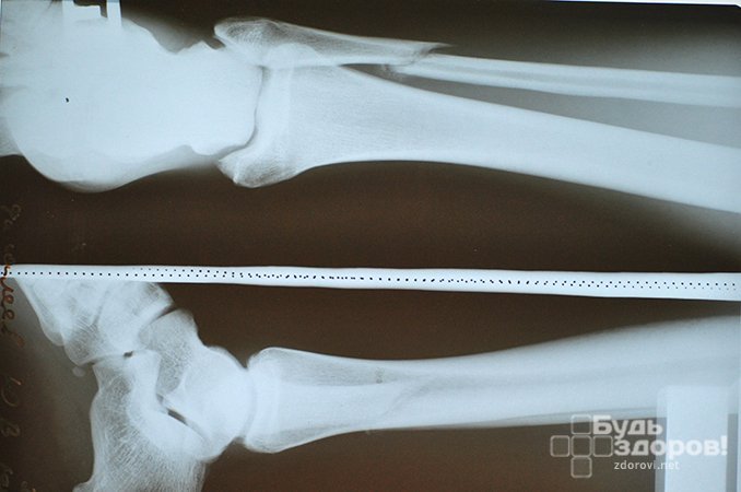Перелом малой берцовой кости - травма нижних конечностей