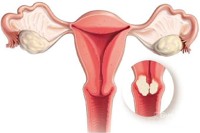 Рак эндометрия - распространенный вид рака женских половых органов