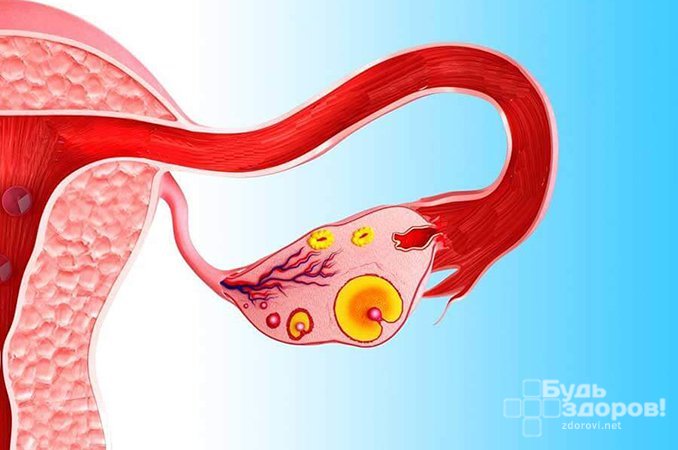 Воспалительный процесс - одна из причин фибромы яичника