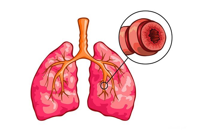Экспираторная одышка – симптом обструкции дыхательных путей