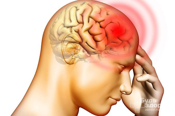 Ушиб головного мозга - черепно-мозговая травма