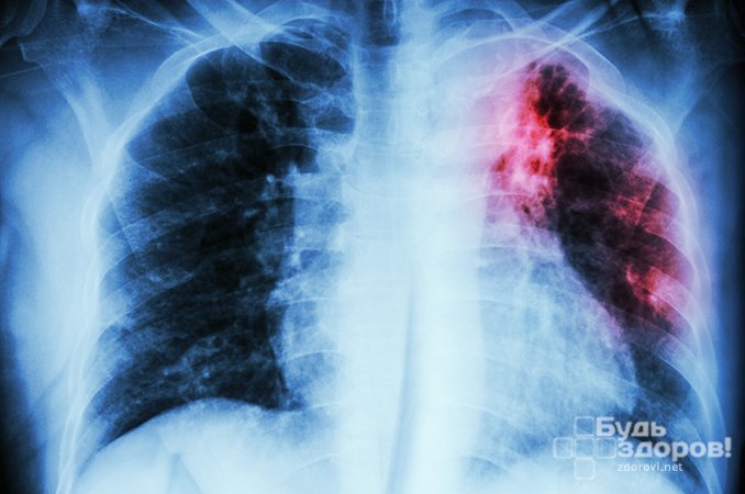 Основная характеристика милиарного туберкулеза - густая диссеминация мелких бугорков