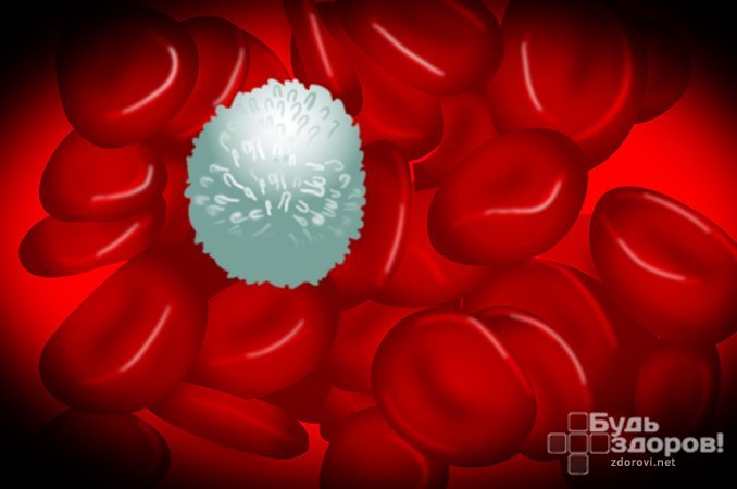 Рак крови — бесконтрольное деление и мутация кроветворных клеток, клеток костного мозга и клеток лимфатической системы