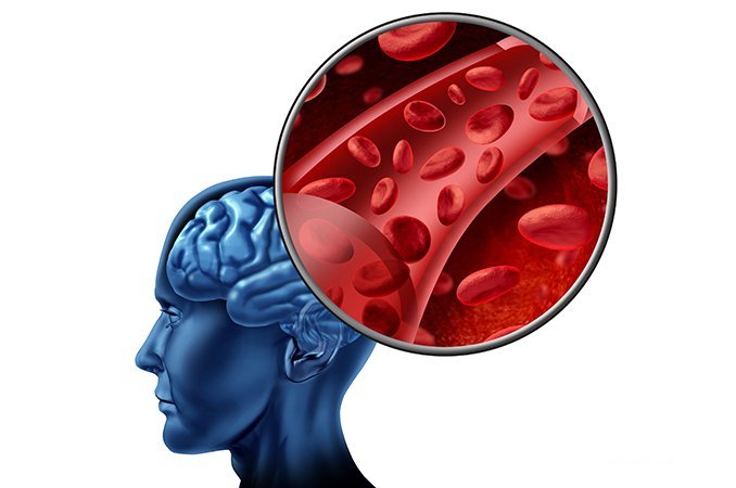 Атеросклероз - одна из наиболее частых причин нарушения мозгового кровообращения