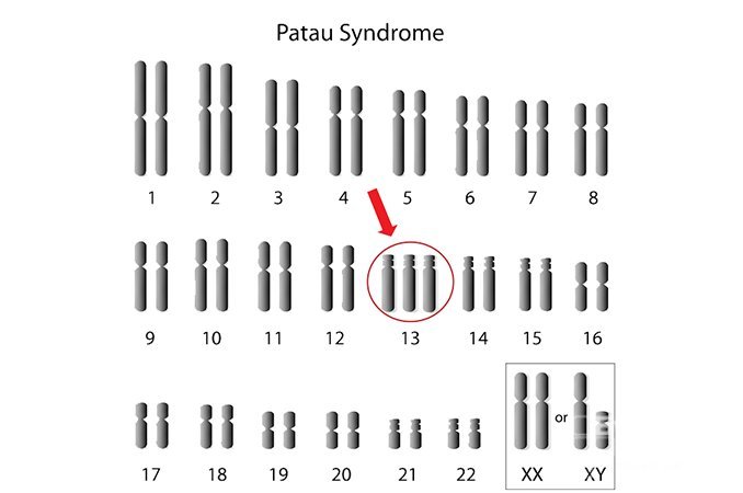 Синдром Патау – аномалия, обусловленная наличием дополнительной копии 13 хромосомы