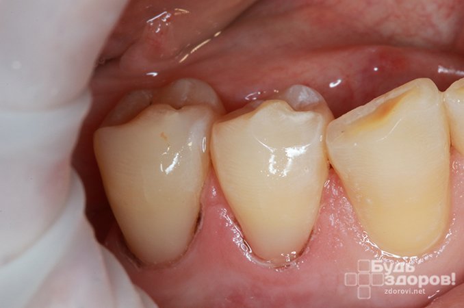 Клиновидный дефект эмали зуба