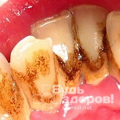 Плохая гигиена рта - одна из причин образования зубного камня