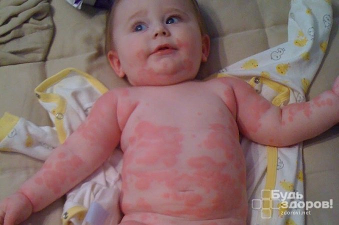 Крапивница у детей – аллергическое заболевание