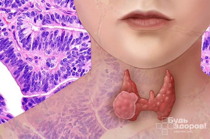 Рак щитовидной железы - злокачественное образование
