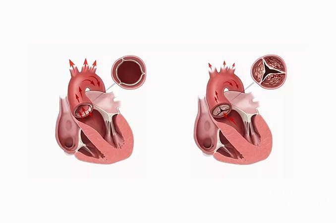 Врожденный порок сердца - группа заболеваний, связанных с анатомическими дефектами сердца