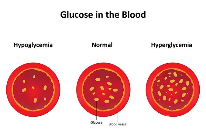 Гипергликемия - повышенное содержание сахара в крови