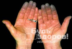 В особо тяжелых случаях при болезни Рейно может развиться гангрена пальцев