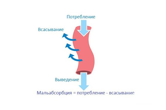 Мальабсорбция - нарушение всасывания в кишечнике
