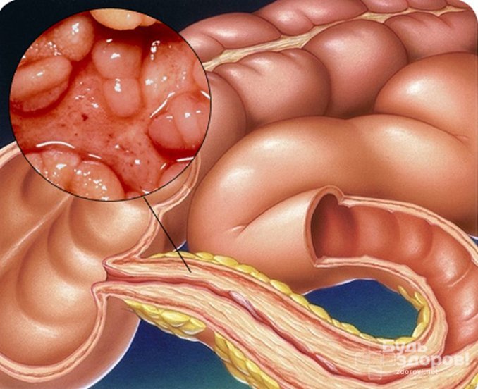 Болезнь Крона – воспалительное заболевание пищеварительного тракта с поражением кишечника