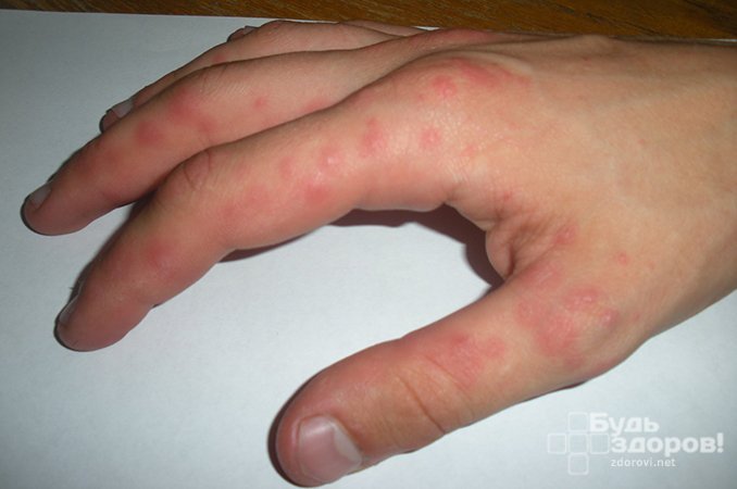Сыпь на руках - один из симптомов энтеровирусной инфекции
