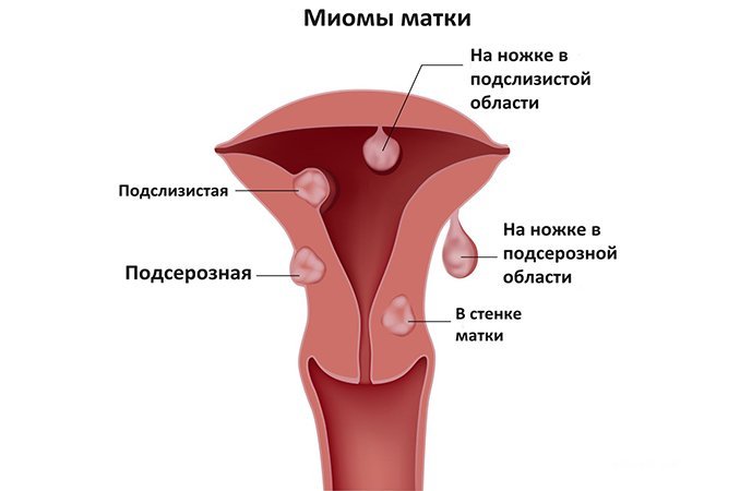 Миома матки - одно из самых частых гинекологических заболеваний