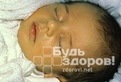 Желтуха у ребенка может быть симптомом болезни Вильсона-Коновалова