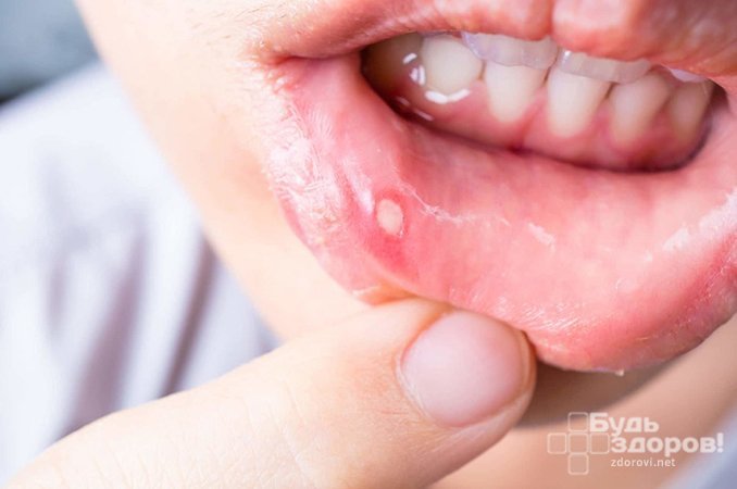 Специфическая сыпь на губах - симптом герпетического стоматита