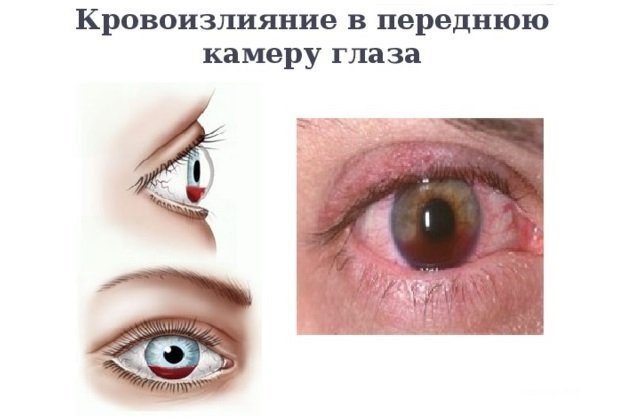 Кровоизлияние в переднюю камеру глаза