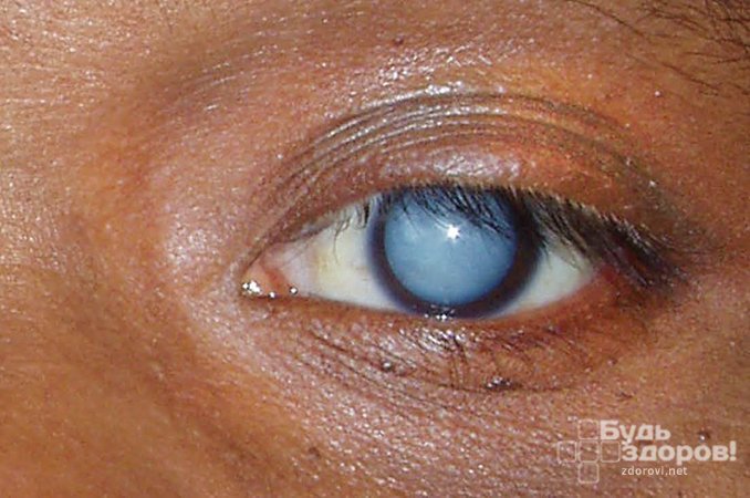 Бельмо на глазу (лейкома) – это помутнение роговицы
