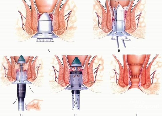 Степлерная геморроидопексия (операция Лонго) при геморрое у мужчин