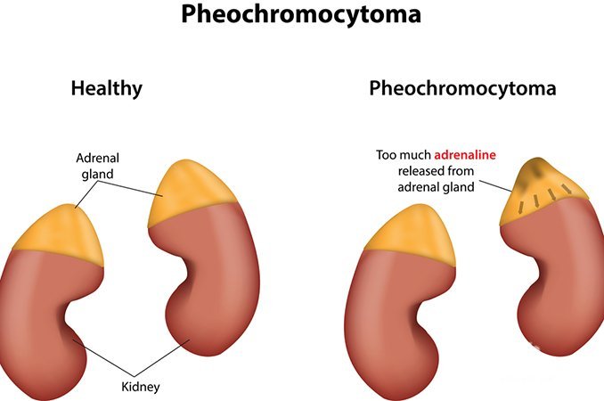 Феохромоцитома — доброкачественная опухоль мозгового вещества надпочечников