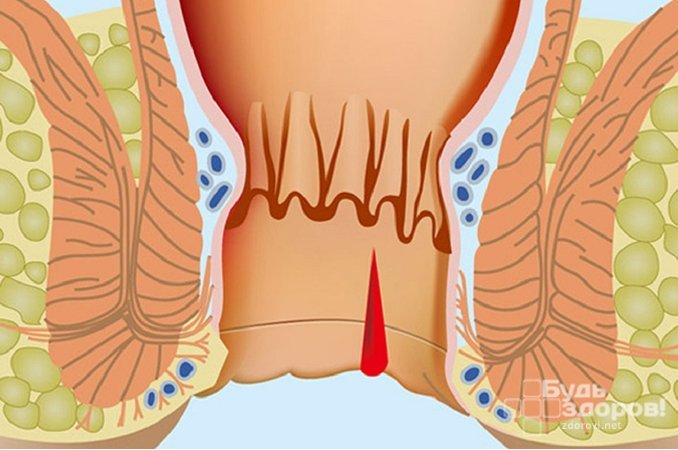 Геморрой - одна из причин анальной трещины