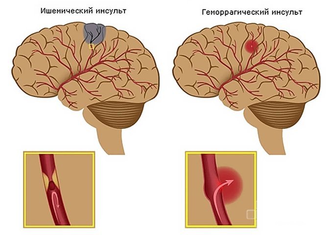 Инсульт - острое нарушение мозгового кровообращения