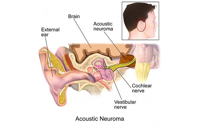 Локализация невриномы слухового нерва