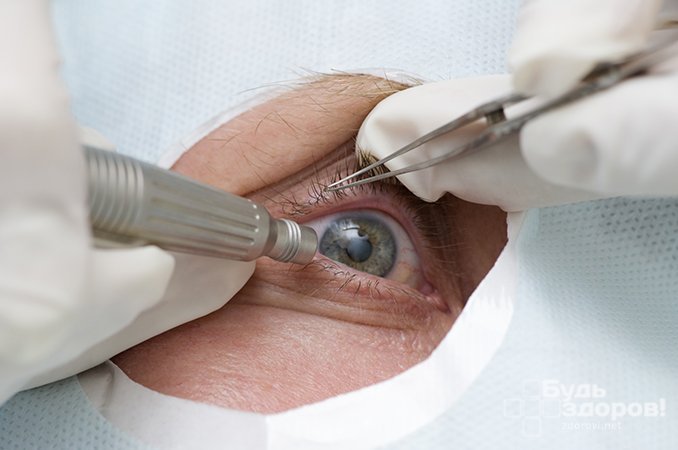 Способы удаления инородного тела из глаза