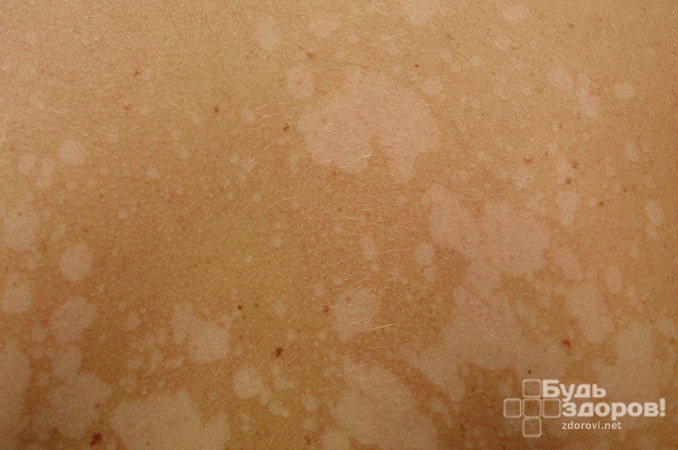 Отрубевидный лишай - грибковое заболевание рогового слоя кожа
