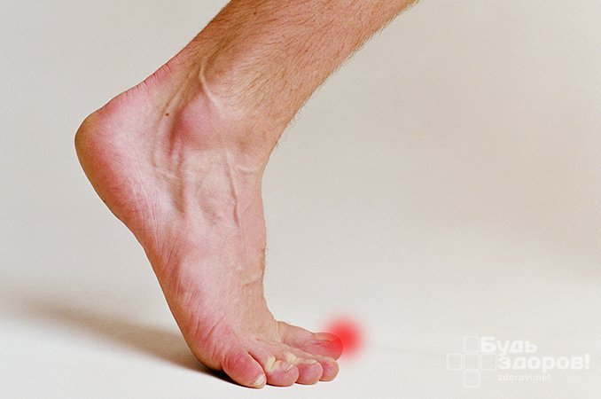 Интенсивная острая боль - симптом перелома пальца ноги