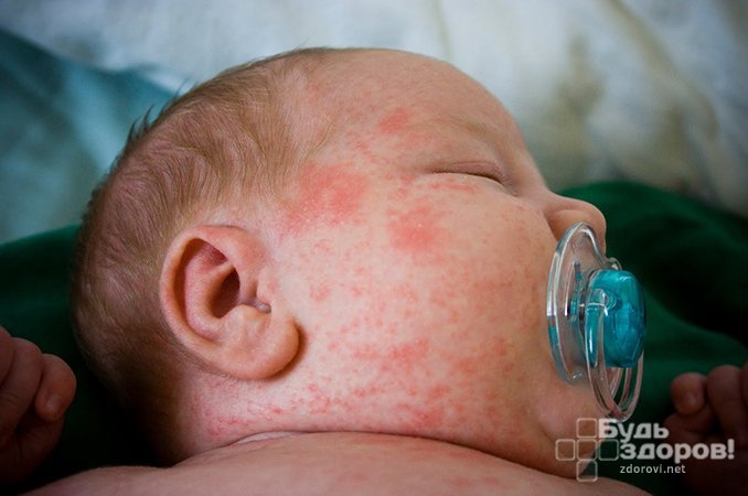Красно-серые пятна с небольшими пузырьками в центре - основной симптом токсической эритемы новорожденных