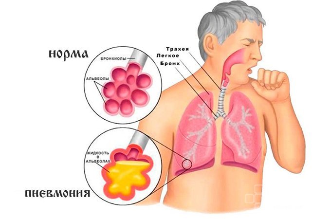 Кашель с мокротой - один из симптомов пневмонии