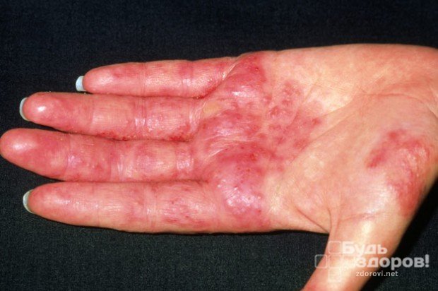Аллергический дерматит: симптомы и лечение