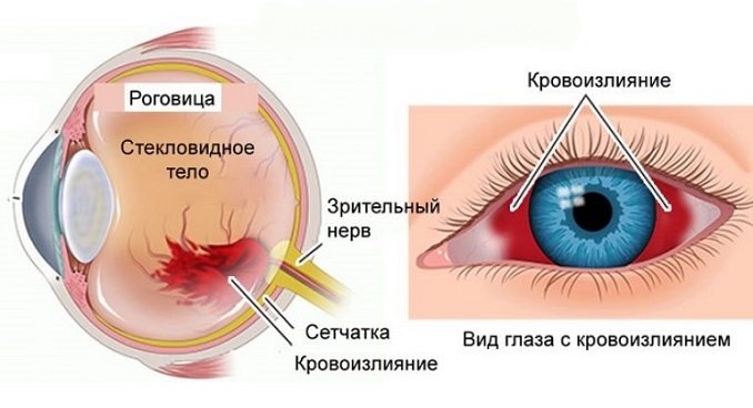 Кровоизлияние в глаз что делать в домашних условиях Кровоизлияние в глаз что делать в домашних условиях