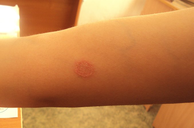 Трихофития - причины, лечение, классификация, диагностика