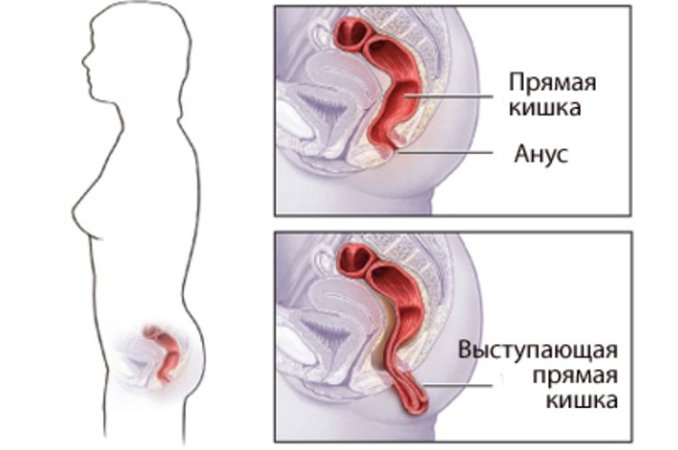 Анус кишка анальный секс фото Анус кишка анальный секс фото