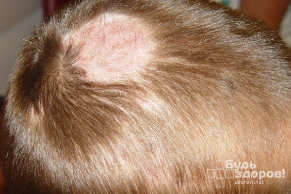Микроспория волосистой части головы