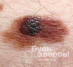 Одна из форм рака кожи - меланома