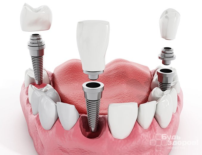 Имплантация зубов: особенности подготовки и преимущества