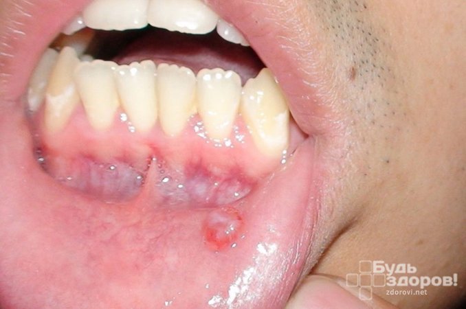 Шишки на губах – один из симптомов рака полости рта