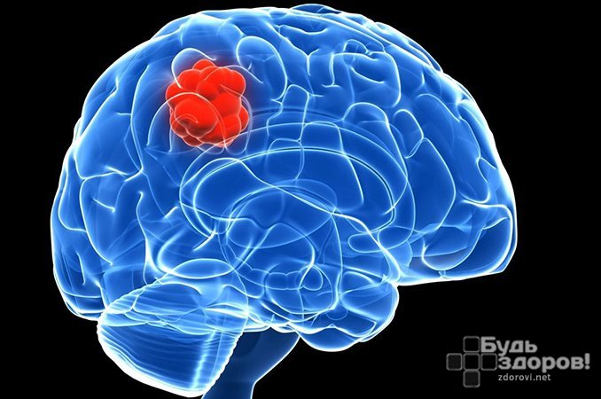 Внутричерепное злокачественное новообразование - рак головного мозга