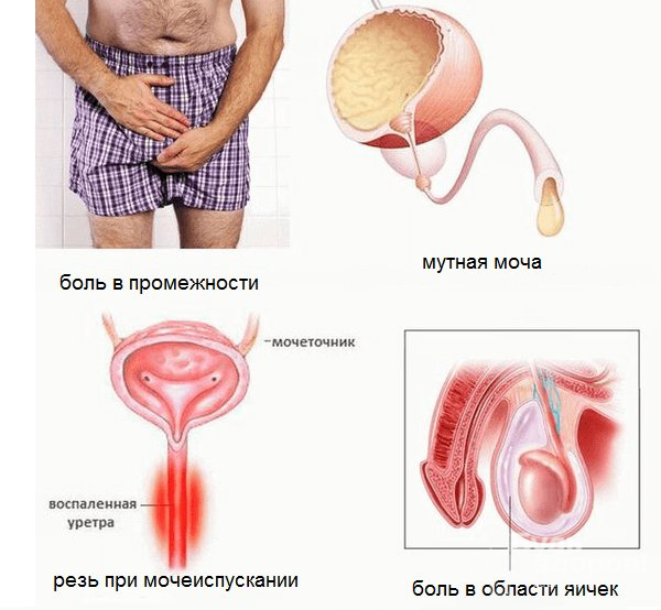 Симптомы уреаплазмоза у мужчин