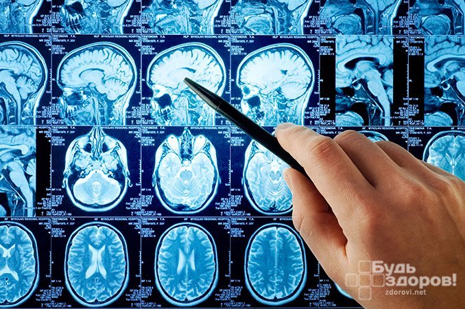 Компьютерная томография - метод диагностики рака головного мозга