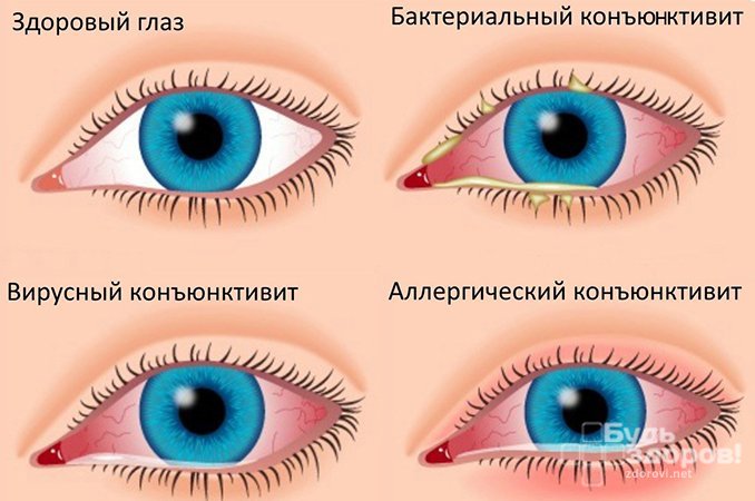 Конъюнктивит — воспаление ткани, покрывающей внутреннюю поверхность века и видимую часть склеры 