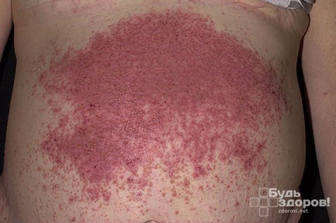 Полиморфная сыпь - основной симптом герпетиформного дерматита