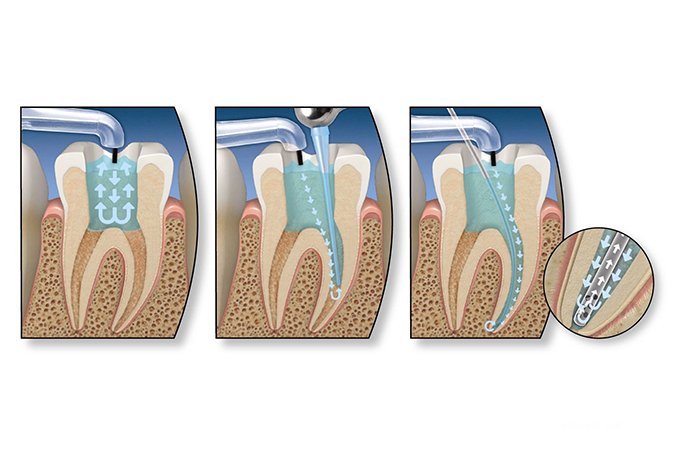 Обтурация корневых каналов зуба